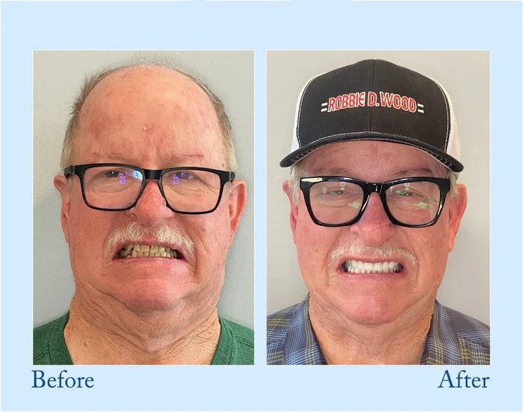 ๐๐ข๐๐จ๐ง๐ยฎ ๐ฆทAdvanced Customized Full Denture Set๐ฆท (๐ฅ10,000+ Sold In Last 30 Day)