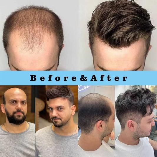 【Get Your Confidence Back】| The Most Natural Looking Toupee for Men | Free Shipping